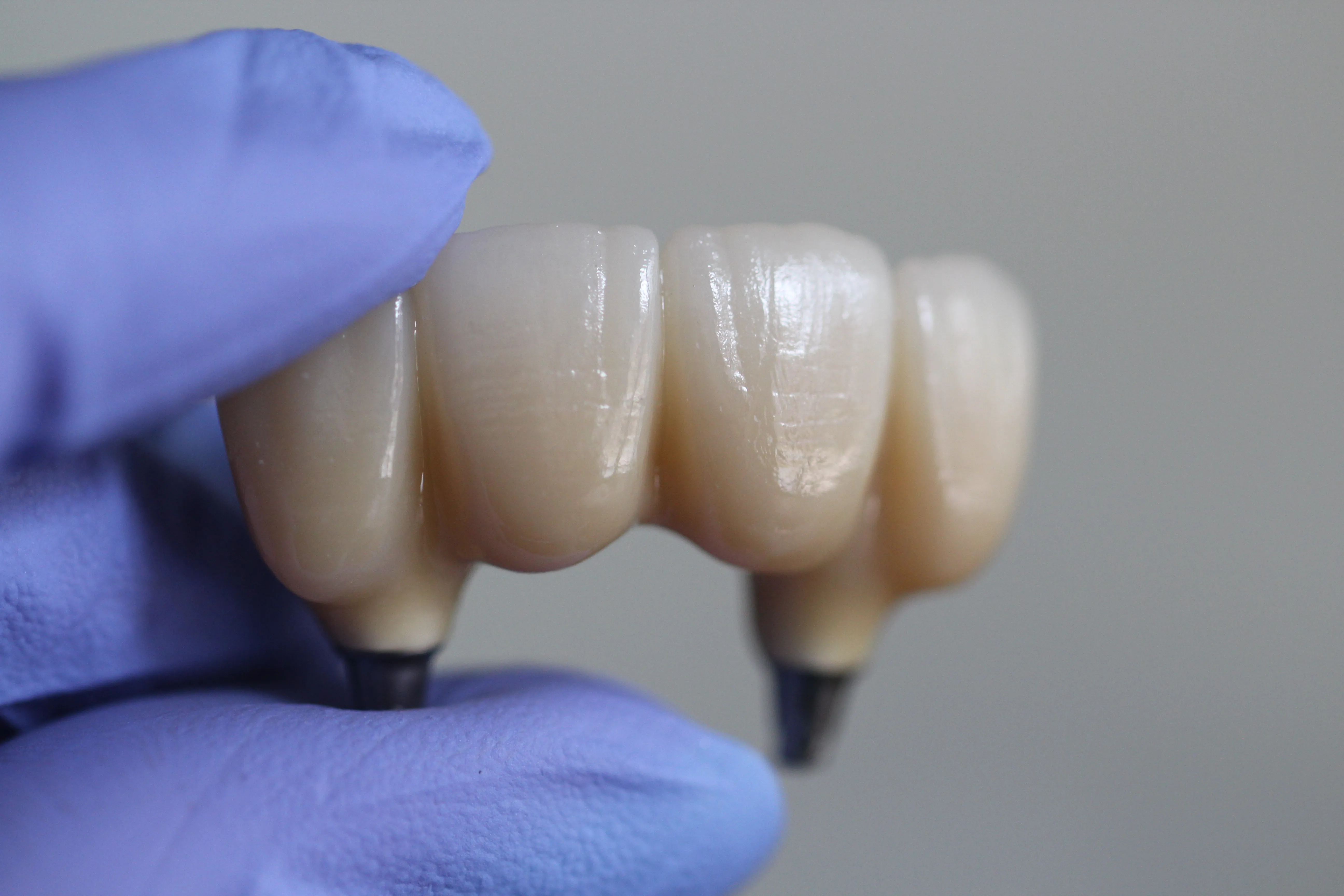 Dantų implantacija Klaipėdoje