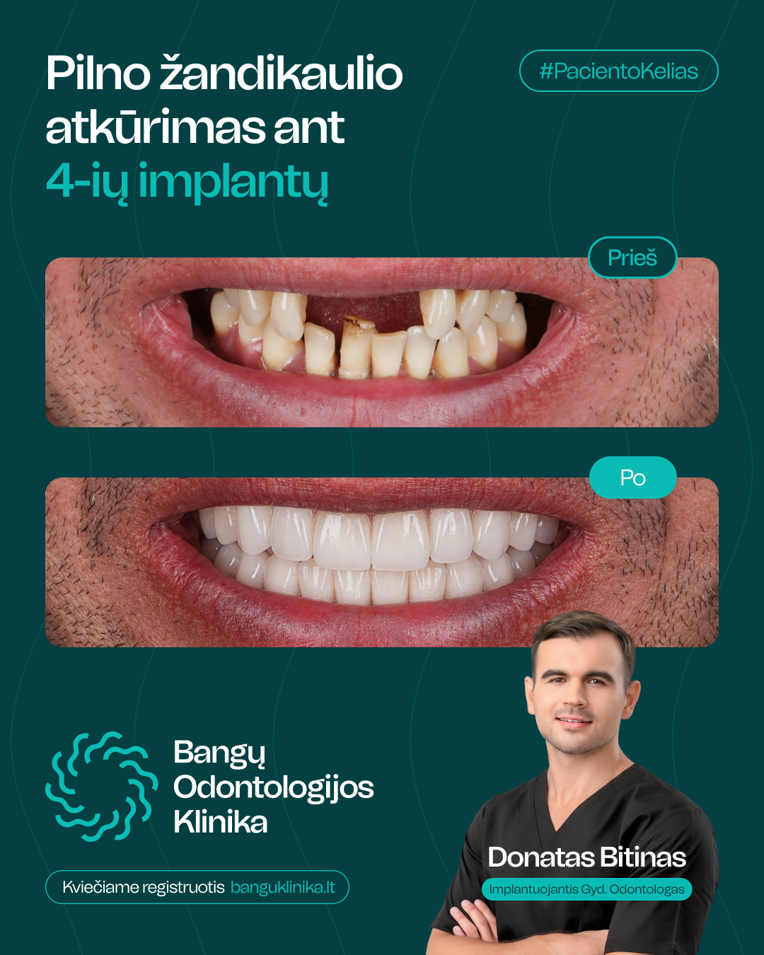 All-on-4 implantācija — pirms un pēc