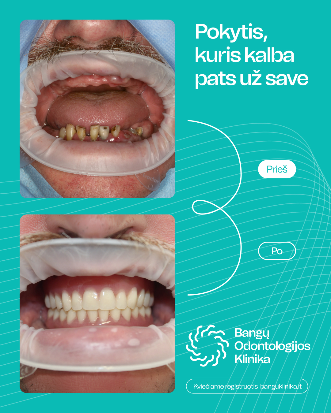 All-on-4 implantācija — pirms un pēc